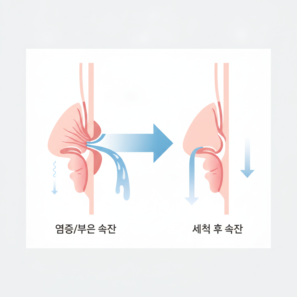 비염 코세척기 추천: 3-in-1 비강관리키트로 코막힘, 콧물 관리 가이드 - 비강 구조와 코막힘 원리 설명 그림